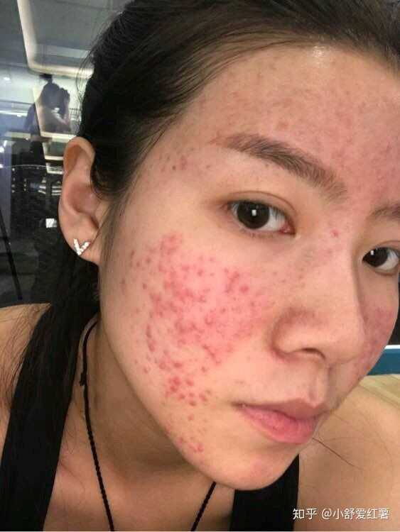 如何有效去除臉上的痘印——全方位指南,全方位指南,如何有效去除臉上痘印的方法