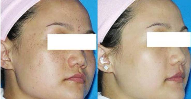 激光祛斑后需要注意的五大事項,激光祛斑后的五大注意事項詳解