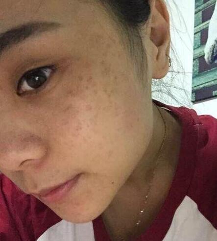 如何有效去除老年斑,全面解析與實用建議,全面解析實用建議,如何有效去除老年斑