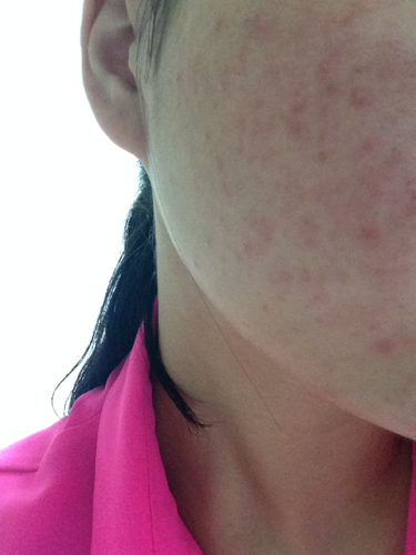 臉上突然長(zhǎng)了好多紅色的痘痘，原因、治療與預(yù)防，臉部紅色痘痘，成因、治療與預(yù)防措施