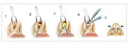 微調鼻子需要多少錢，全面解析費用因素與注意事項，微調鼻子費用全解析，費用因素與注意事項，需要多少錢？