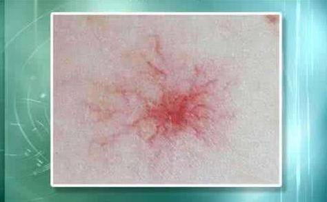 肝癌身上出現紅點圖片，癥狀解析與關注，肝癌身上紅點解析，癥狀、圖片及關注重點