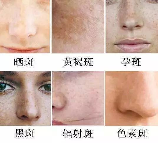 如何有效去除臉上斑點(diǎn)——全方位指南，全方位指南，如何有效去除臉上斑點(diǎn)