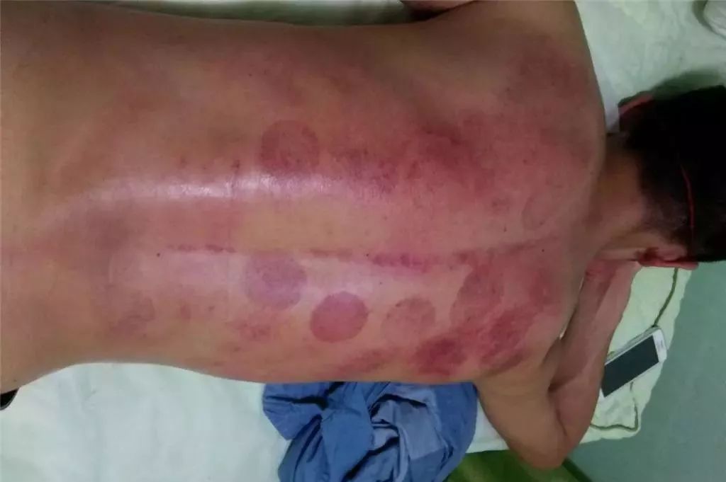 艾灸后如何判斷濕氣排出——一種直觀而實用的方法,艾灸后判斷濕氣排出的實用方法指南