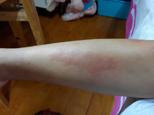 我用偏方成功治愈蕁麻疹，經歷與分享，我用偏方成功治愈蕁麻疹，經歷分享與治愈之路