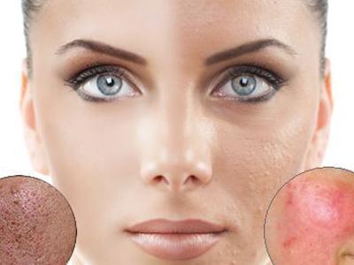 祛痘印小妙招,簡單實(shí)用,告別痘痘痕跡,祛痘印小妙招,告別痘痘痕跡,重拾肌膚光彩