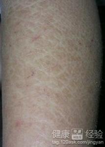 魚鱗皮膚病如何才能根治，全面解析與應對策略，全面解析魚鱗皮膚病根治之道，應對策略大揭秘