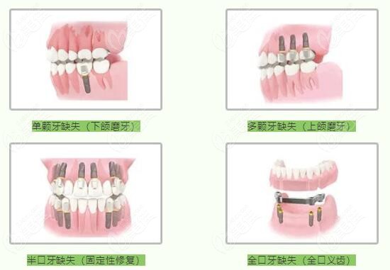 種牙多少錢一顆牙價格表2023，全面解析種植牙費用及影響因素，2023年種植牙價格表全面解析，費用、影響因素一網打盡