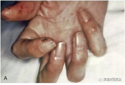 甲流感癥狀有哪些,甲流感癥狀詳解