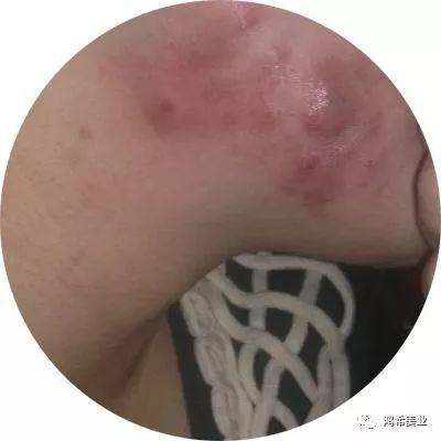 七種痘痘的種類圖解及其成因與防治策略,七種痘痘種類圖解,成因、防治策略全解析