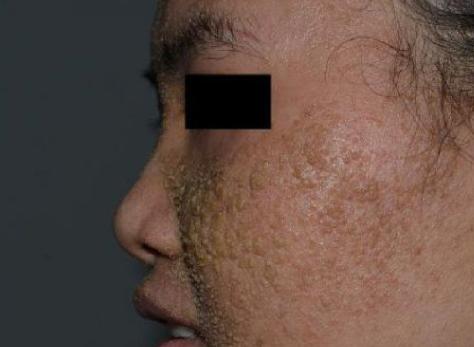 七種痘痘的種類圖解及其成因與防治策略,七種痘痘種類圖解,成因、防治策略全解析