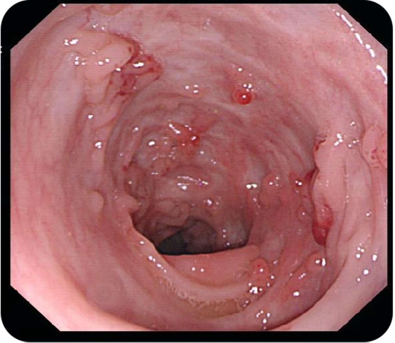 克羅恩病最常見的癥狀是什么？一篇文章深度解析，深度解析，克羅恩病最常見癥狀解析