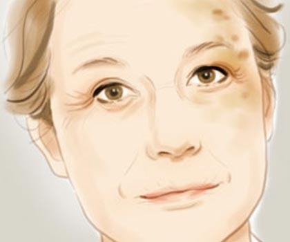 如何有效去除老年斑——全方位解析,全方位解析,有效去除老年斑的方法