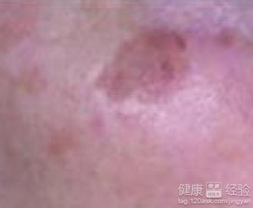 如何有效去除老年斑——全方位解析,全方位解析,有效去除老年斑的方法