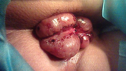 外痔清晰圖片及其相關知識解析,外痔圖片與相關知識詳解