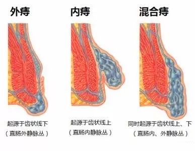 外痔清晰圖片及其相關知識解析,外痔圖片與相關知識詳解