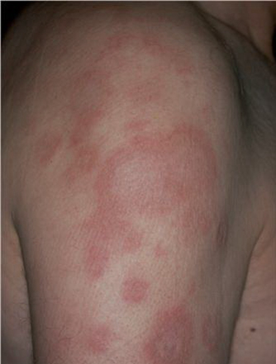 艾滋病紅斑早期圖片，了解、預(yù)防與應(yīng)對，艾滋病紅斑早期圖片詳解，預(yù)防與應(yīng)對策略