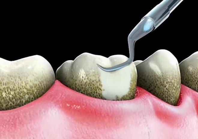 去牙科洗一次牙的價格是多少?全面解析洗牙費用,洗牙費用全面解析,牙科洗牙價格一覽