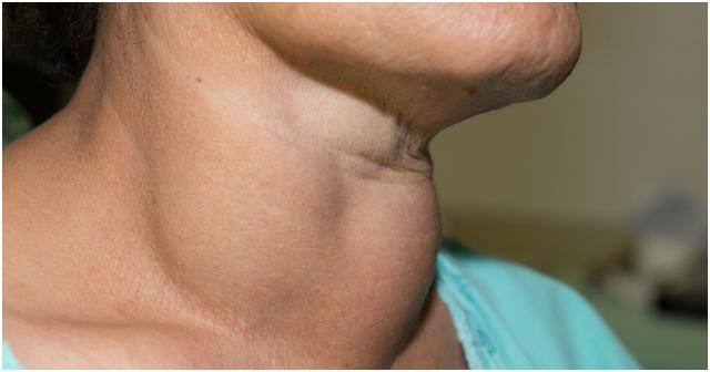 女性甲狀腺早期脖子圖片及其相關(guān)知識(shí)與識(shí)別,女性甲狀腺早期脖子癥狀圖片及識(shí)別與相關(guān)知識(shí)