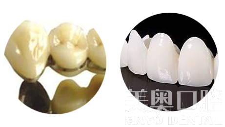 烤瓷牙和全瓷牙的利與弊，深度解析，深度解析，烤瓷牙與全瓷牙的優缺點對比