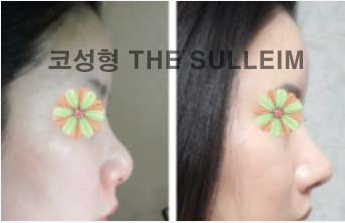 如何縮小鼻翼不手術，實用方法與建議，不手術縮小鼻翼的實用方法與建議