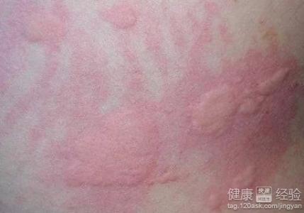 風疹是怎么引起的,風疹的成因解析