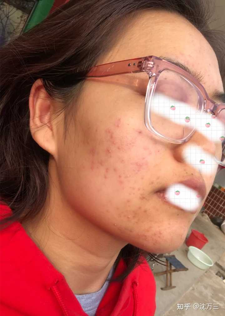 消除痤瘡留下的紅色痘印的有效方法,消除紅色痘印,痤瘡后的護膚秘訣