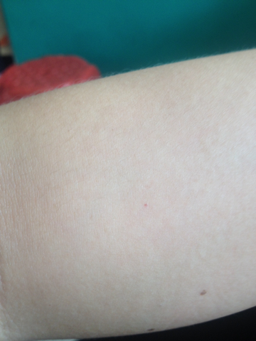 皮膚下有小紅點像滲血,原因、診斷與處理方法,皮膚小紅點疑似滲血,原因、診斷及處理方法全解析