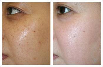 如何淡化色斑——全方位美白祛斑攻略,全方位美白祛斑攻略,如何有效淡化色斑