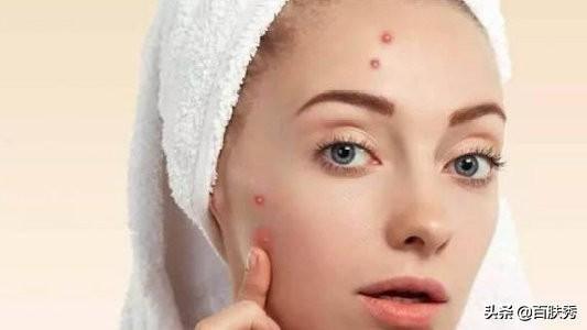 痤瘡是什么——深入了解痤瘡的成因、癥狀與治療方法，痤瘡解析，成因、癥狀及治療方法全面介紹