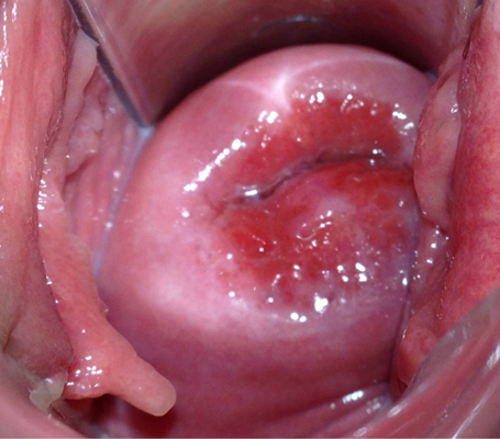宮頸糜爛的癥狀及其影響，了解、預防與治療，宮頸糜爛的癥狀、影響、預防與治療全解析